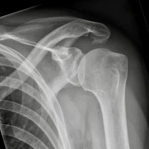 Impingement
